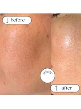 ファーノ/毛穴のディープクレンジング