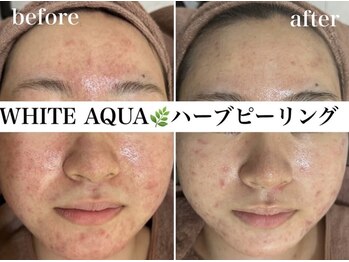 ホワイトアクア 浜松店(WHITE AQUA)/ハーブピーリング/ニキビケア