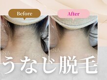 フェルナ 上新庄店(FERNA)の雰囲気（うなじ脱毛BeforeAfter☆うなじはシェービング無料です♪）