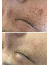 ビューティリュクス(beauty luxe)/シミくすみ肌には光とプラズマ！