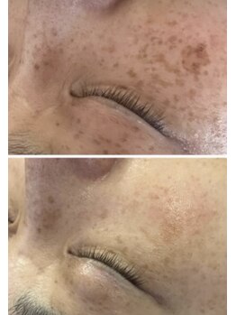 ビューティリュクス(beauty luxe)/シミくすみ肌には光とプラズマ！