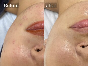 ホーミー(Homie)/ニキビ改善、赤みニキビ改善