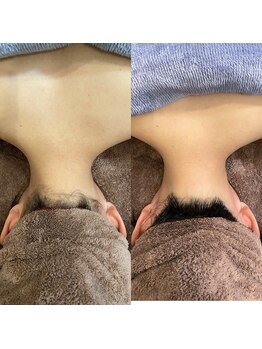 フォルチェ 春日(Folche)/うなじ脱毛で後ろ姿美人へ