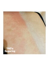 ヒロット タオ(HILOT TAO)/Sugaring 背中脱毛