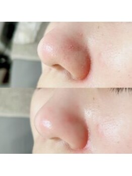 リィプラス(Re+)/毛穴洗浄