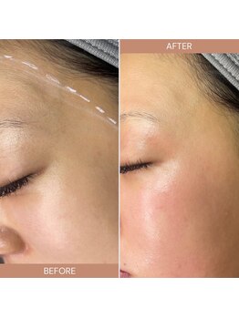 スー 梅田(suu)の写真/【フェイシャルワックス】で毛穴の汚れや皮脂のつまり・産毛・古い角質を取り除き美肌の土台を作り艶肌へ◎