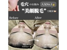 エステティック レイビス 八戸店(RAYVIS)/毛穴のお悩みにも顔脱毛で解決！