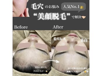 エステティック レイビス 八戸店(RAYVIS)/毛穴のお悩みにも顔脱毛で解決！