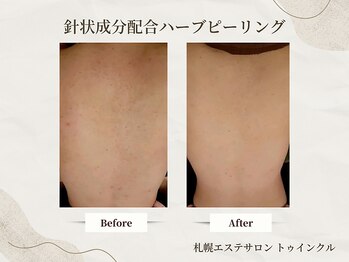 プライベートエステサロン トゥインクル/背中全体のくすみ・黒ずみ一掃！