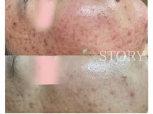 ストーリー 岐阜店(STORY)/ハーブピーリング専門店STORY