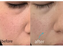 ルーム701(room701)/たるみ毛穴　肌引き締め