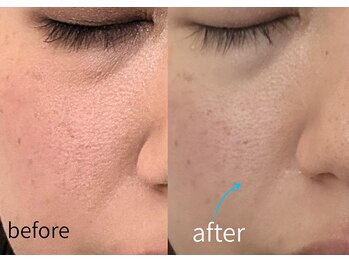 ルーム701(room701)/たるみ毛穴 肌引き締め