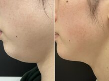 ピュアリー(purly)/【レモンボトル】Before After