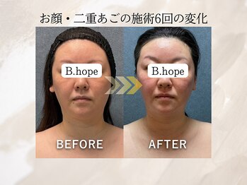 ビーホープ(B.hope)の写真/施術後から実感◎最新サーモシェイプopus導入！高周波×脂肪ケアを組み合わせた小顔・美肌マシン♪