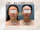 ビーホープ(B.hope)の写真/施術後から実感◎最新サーモシェイプopus導入！高周波×脂肪ケアを組み合わせた小顔・美肌マシン♪