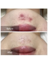 ダリア(Dahlia)/プラズマシャワー