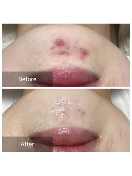 ダリア(Dahlia)/プラズマシャワー