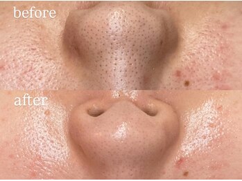 ビビ(Vivi)/お鼻の黒ずみ