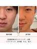 クレスカピーリングお試し
