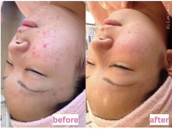 アドミーロ/ニキビ/毛穴ケア/肌トラブルに☆