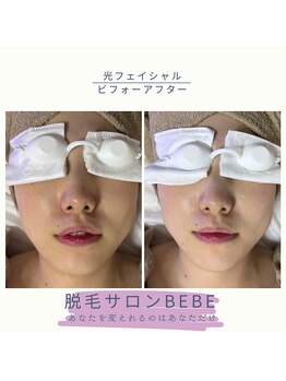ベベ(Bebe)/光フェイシャル♪