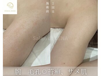 サロンドレナ 名駅店/ハーブピーリング サロンドレナ