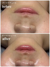 ビズエー(viz.A)/ダーマクチュール