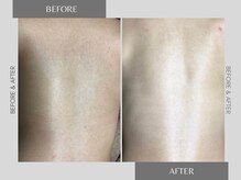 テリー(Terry)/レディース脱毛before after