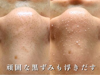 ダリア(Dahlia)/頑固な黒ずみ毛穴に