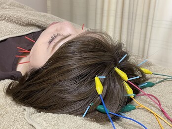 泉町鍼灸整骨院/頭鍼　