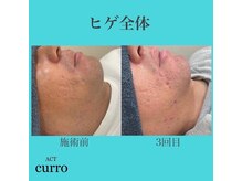 アクト クロ(ACT curro)/【ヒゲ全体】脱毛施術例