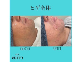 アクト クロ(ACT curro)/【ヒゲ全体】脱毛施術例