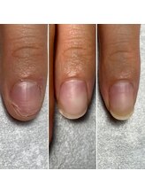 トレフル(Trefle)/むしり癖でダメージを受けた爪も