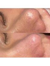 シャルム(CHARMER)/黒いちご鼻さよなら毛穴洗浄