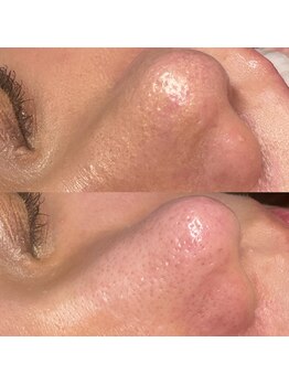 シャルム(CHARMER)/黒いちご鼻さよなら毛穴洗浄