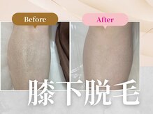 フェルナ 上新庄店(FERNA)の雰囲気（膝下脱毛BeforeAfter☆膝下・膝上どちらでも膝小僧含まれます！）