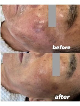 ビビット 久宝寺店(VIVIT)/肌質改善/シミシワたるみエステ