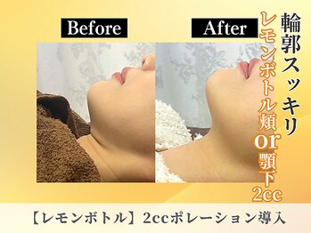 ポーベルポー(Peau Belle poe)/【レモンボトル】2cc顎下たるみ