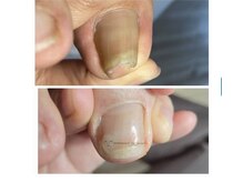 ドクターネイル爪革命 岡山店/巻き爪改善