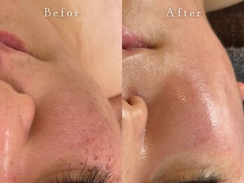 サロン アイプラス(salon i plus)/シミ/毛穴開き