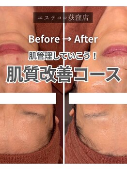 エステ ココ 荻窪店(Esthe CoCo)/美肌/肌管理/毛穴