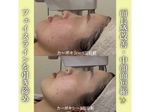 ハニエル(Haniel)/カーボキシー症例