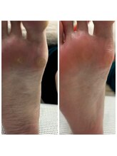 ドクターネイル爪革命 十条店/たこケア