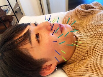 コス(KOS)/美容鍼