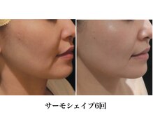 Nビューティー/最新RFサーモシェイプオーパス