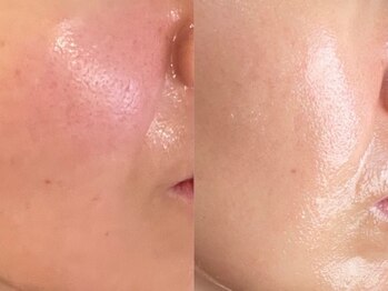 ユウビ ビューティー サロン(Yuubi)/【peel stage】ハーブピーリング