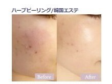 エタニティ 西宮店(Eternity)/韓国ハーブピーリング