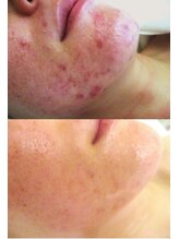 サロンドエステケイワイ(de KY)/フェイシャル☆ニキビ改善