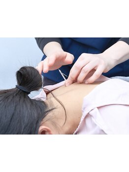 鍼灸施術を受けたい