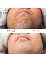 エヌアール(NR)/men's ヒゲ脱毛